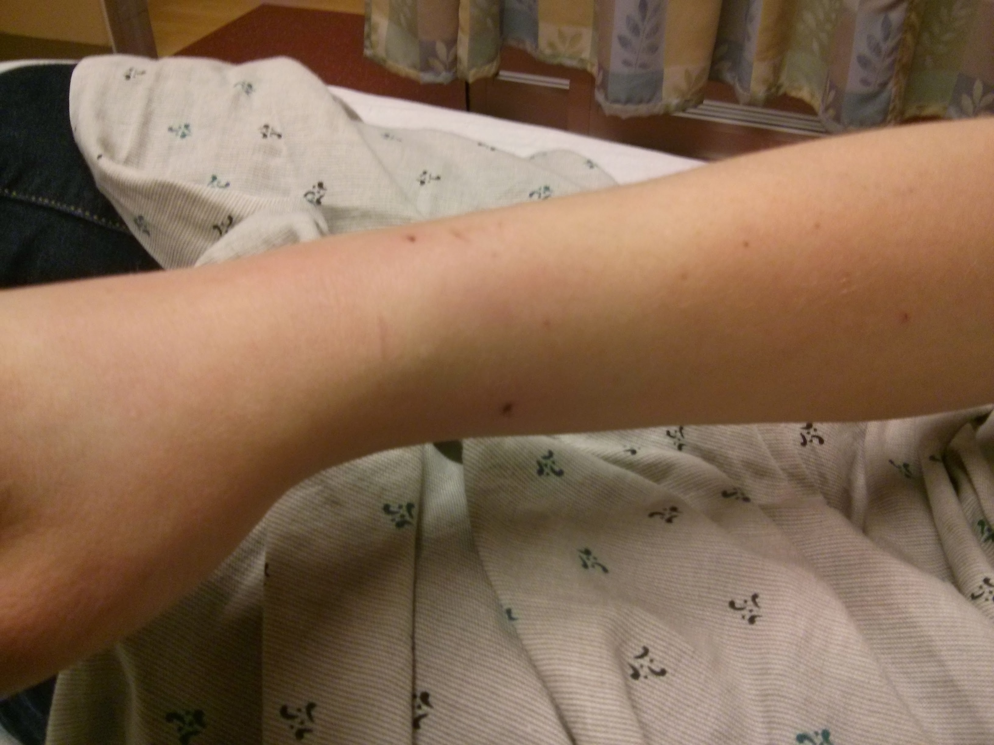 Christina's arm after Vader objected to his bath